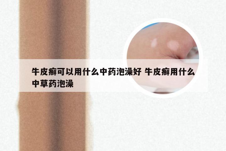 牛皮癣可以用什么中药泡澡好 牛皮癣用什么中草药泡澡