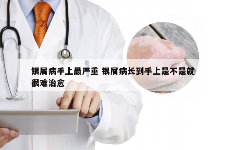 银屑病手上最严重 银屑病长到手上是不是就很难治愈