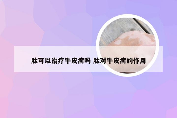 肽可以治疗牛皮癣吗 肽对牛皮癣的作用