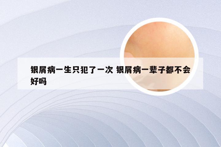 银屑病一生只犯了一次 银屑病一辈子都不会好吗