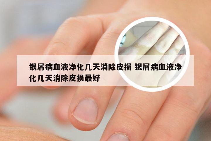 银屑病血液净化几天消除皮损 银屑病血液净化几天消除皮损最好