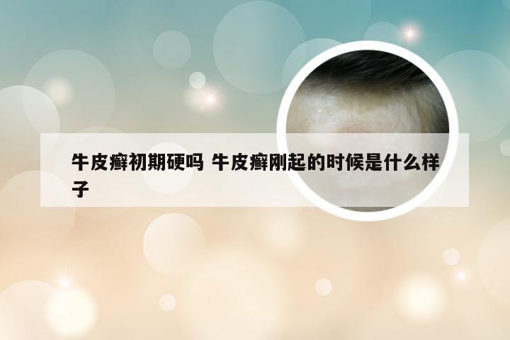 牛皮癣初期硬吗 牛皮癣刚起的时候是什么样子