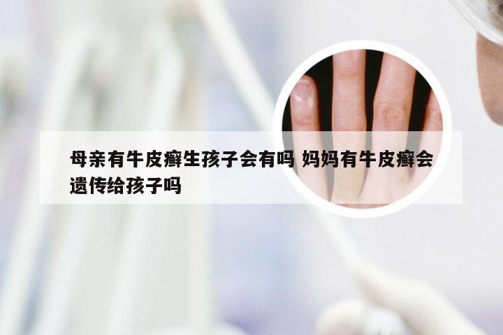 母亲有牛皮癣生孩子会有吗 妈妈有牛皮癣会遗传给孩子吗