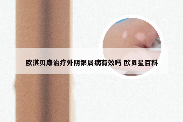 欧淇贝康治疗外阴银屑病有效吗 欧贝星百科