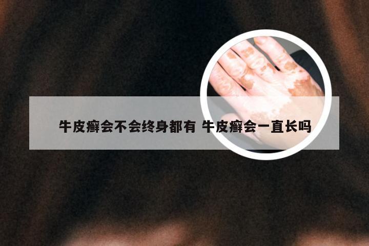 牛皮癣会不会终身都有 牛皮癣会一直长吗