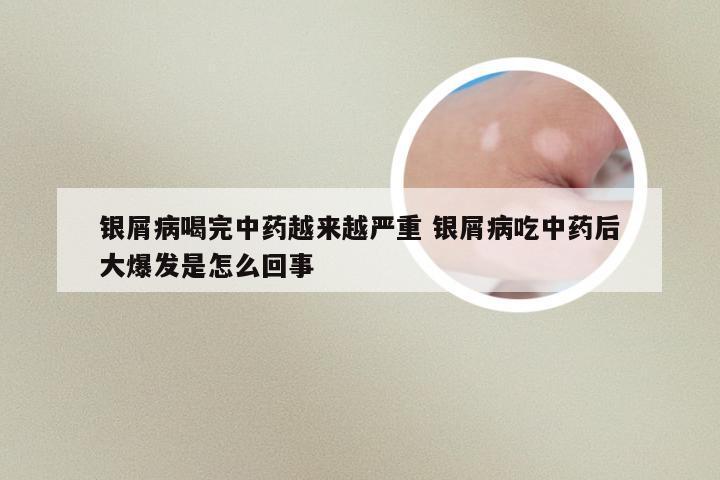 银屑病喝完中药越来越严重 银屑病吃中药后大爆发是怎么回事