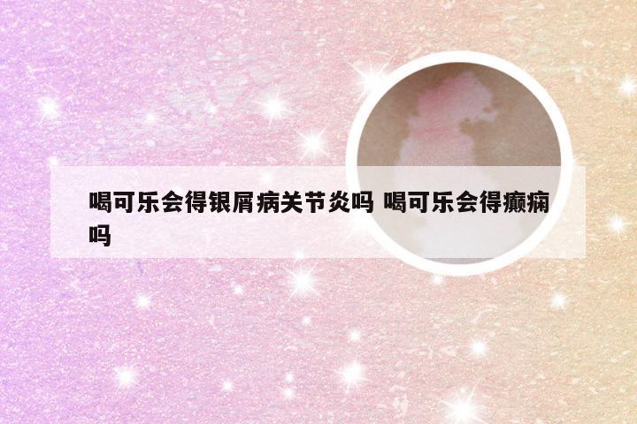 喝可乐会得银屑病关节炎吗 喝可乐会得癫痫吗
