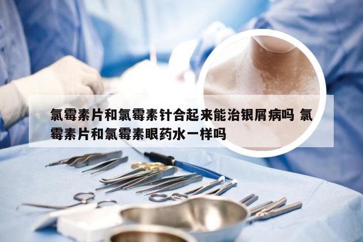 氯霉素片和氯霉素针合起来能治银屑病吗 氯霉素片和氯霉素眼药水一样吗