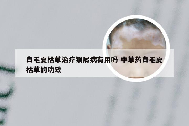 白毛夏枯草治疗银屑病有用吗 中草药白毛夏枯草的功效