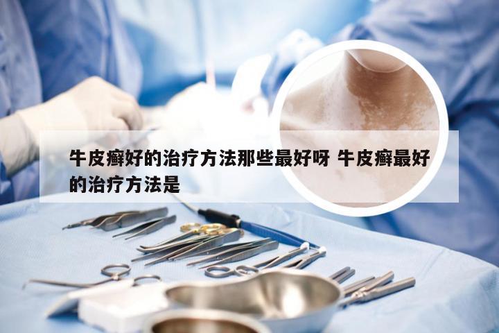 牛皮癣好的治疗方法那些最好呀 牛皮癣最好的治疗方法是