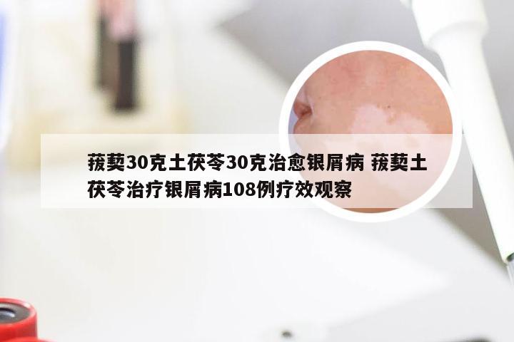 菝葜30克土茯苓30克治愈银屑病 菝葜土茯苓治疗银屑病108例疗效观察