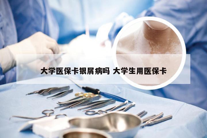 大学医保卡银屑病吗 大学生用医保卡