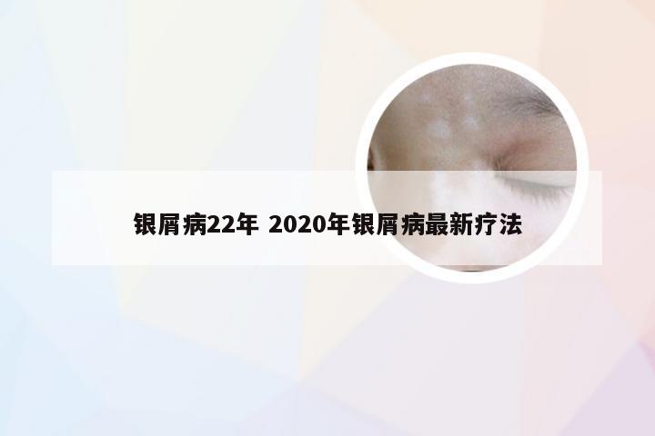 银屑病22年 2020年银屑病最新疗法