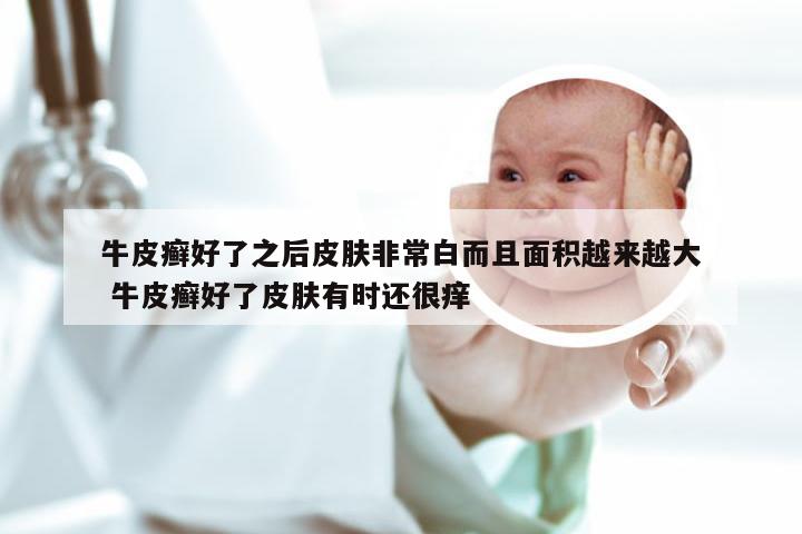 牛皮癣好了之后皮肤非常白而且面积越来越大 牛皮癣好了皮肤有时还很痒