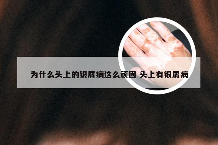 为什么头上的银屑病这么顽固 头上有银屑病