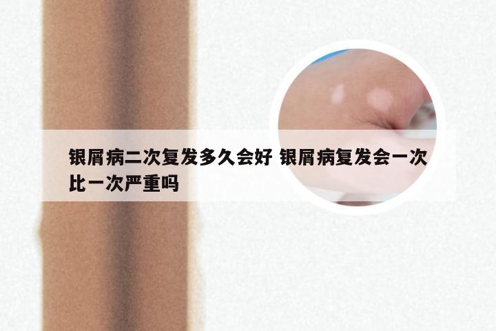 银屑病二次复发多久会好 银屑病复发会一次比一次严重吗
