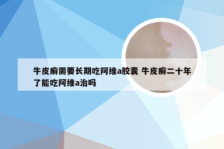 牛皮癣需要长期吃阿维a胶囊 牛皮癣二十年了能吃阿维a治吗