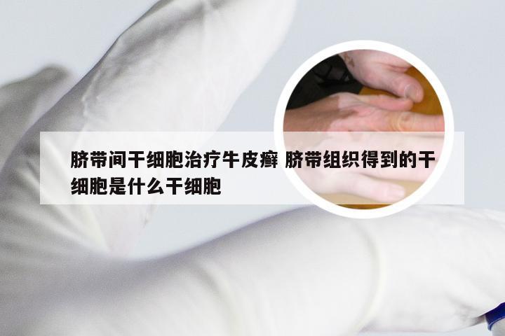 脐带间干细胞治疗牛皮癣 脐带组织得到的干细胞是什么干细胞