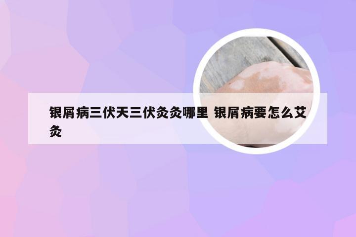银屑病三伏天三伏灸灸哪里 银屑病要怎么艾灸
