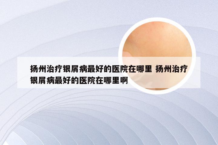 扬州治疗银屑病最好的医院在哪里 扬州治疗银屑病最好的医院在哪里啊