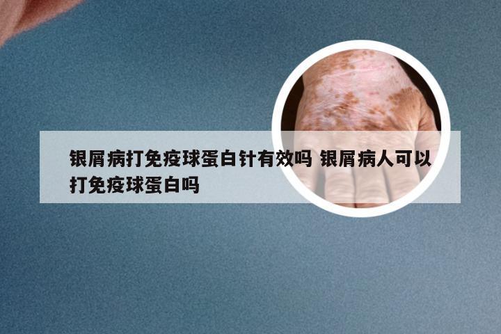 银屑病打免疫球蛋白针有效吗 银屑病人可以打免疫球蛋白吗
