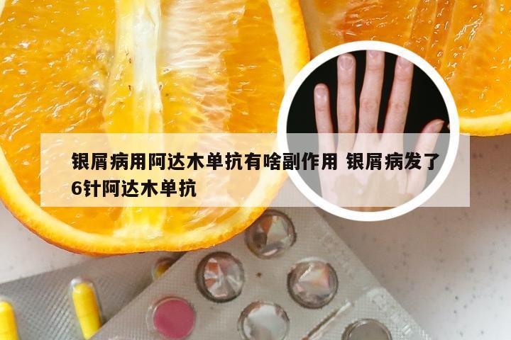 银屑病用阿达木单抗有啥副作用 银屑病发了6针阿达木单抗