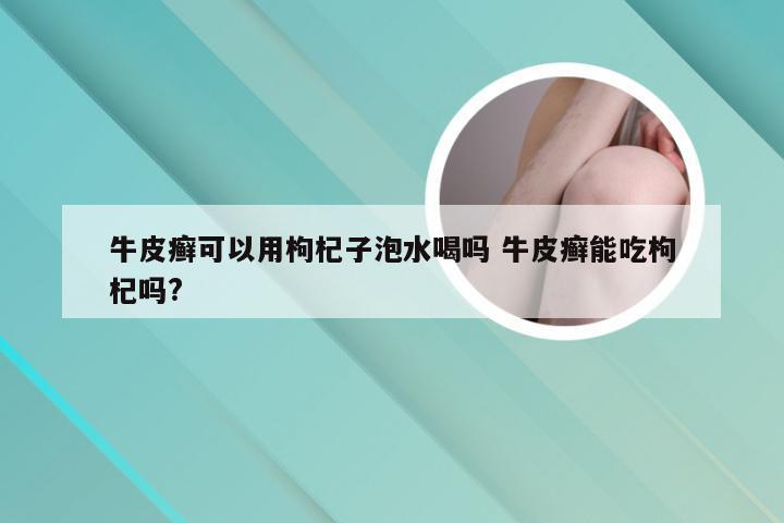 牛皮癣可以用枸杞子泡水喝吗 牛皮癣能吃枸杞吗?