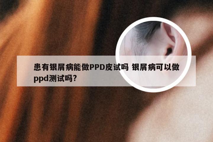 患有银屑病能做PPD皮试吗 银屑病可以做ppd测试吗?