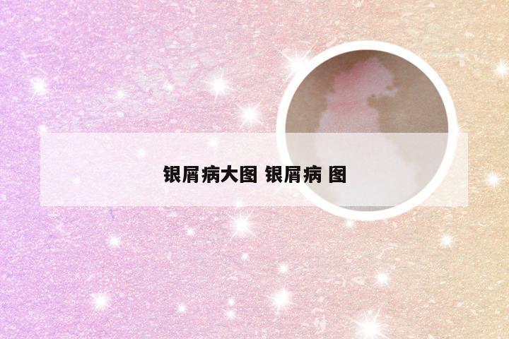 银屑病大图 银屑病 图