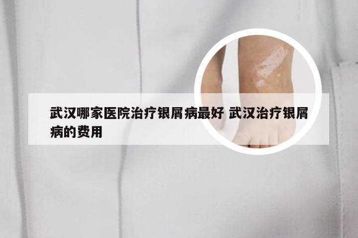 武汉哪家医院治疗银屑病最好 武汉治疗银屑病的费用