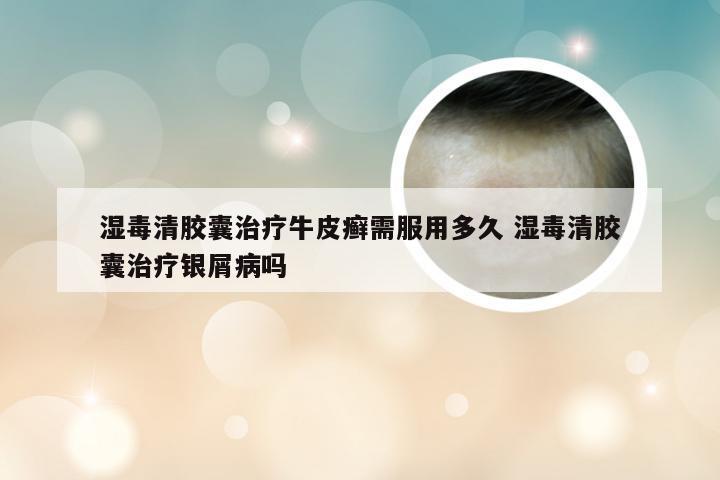 湿毒清胶囊治疗牛皮癣需服用多久 湿毒清胶囊治疗银屑病吗