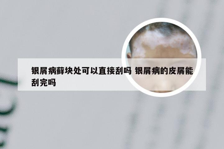 银屑病藓块处可以直接刮吗 银屑病的皮屑能刮完吗