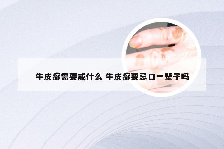 牛皮癣需要戒什么 牛皮癣要忌口一辈子吗