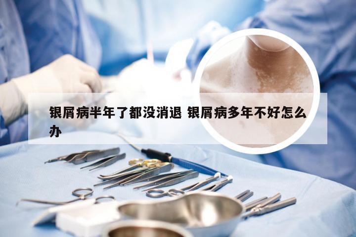 银屑病半年了都没消退 银屑病多年不好怎么办