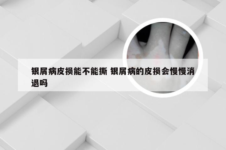银屑病皮损能不能撕 银屑病的皮损会慢慢消退吗