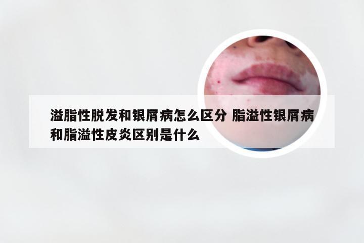溢脂性脱发和银屑病怎么区分 脂溢性银屑病和脂溢性皮炎区别是什么