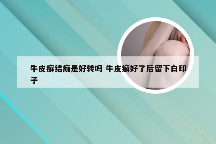 牛皮癣结痂是好转吗 牛皮癣好了后留下白印子