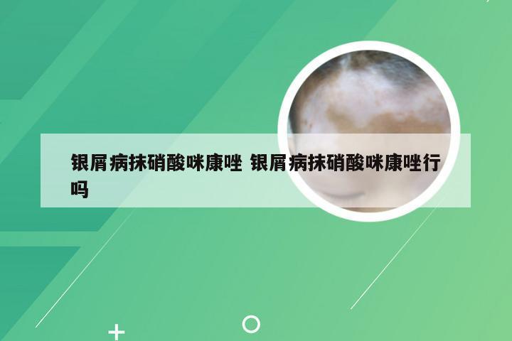 银屑病抹硝酸咪康唑 银屑病抹硝酸咪康唑行吗
