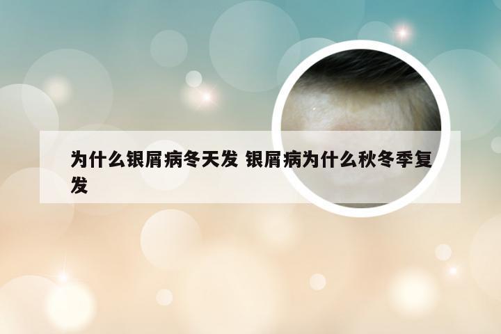 为什么银屑病冬天发 银屑病为什么秋冬季复发