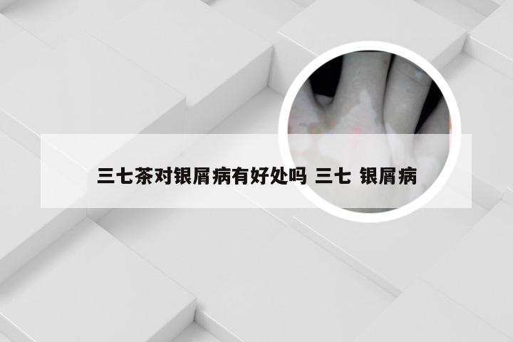 三七茶对银屑病有好处吗 三七 银屑病
