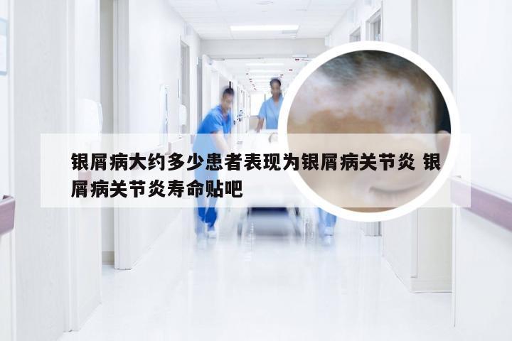 银屑病大约多少患者表现为银屑病关节炎 银屑病关节炎寿命贴吧