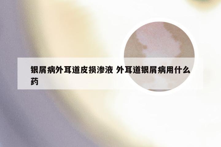 银屑病外耳道皮损渗液 外耳道银屑病用什么药