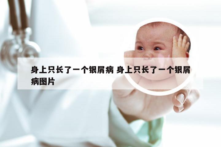 身上只长了一个银屑病 身上只长了一个银屑病图片