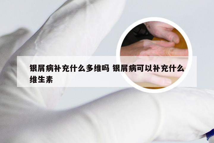 银屑病补充什么多维吗 银屑病可以补充什么维生素