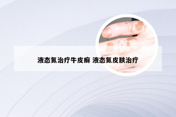 液态氮治疗牛皮癣 液态氮皮肤治疗