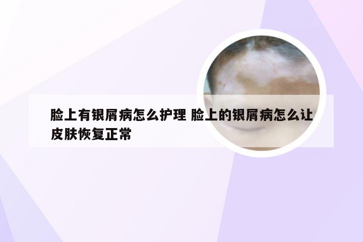 脸上有银屑病怎么护理 脸上的银屑病怎么让皮肤恢复正常