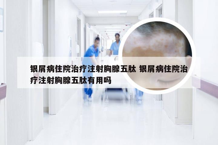 银屑病住院治疗注射胸腺五肽 银屑病住院治疗注射胸腺五肽有用吗