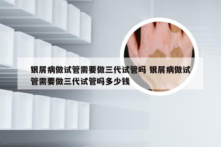 银屑病做试管需要做三代试管吗 银屑病做试管需要做三代试管吗多少钱