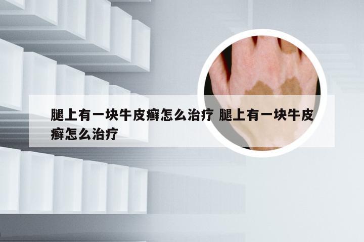 腿上有一块牛皮癣怎么治疗 腿上有一块牛皮癣怎么治疗