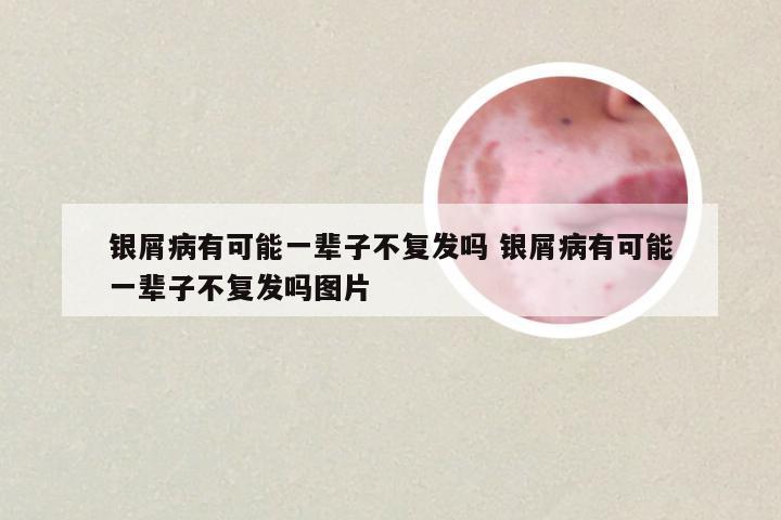 银屑病有可能一辈子不复发吗 银屑病有可能一辈子不复发吗图片